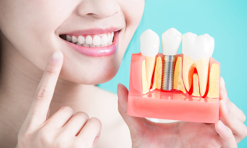 Mouth Dental Implants